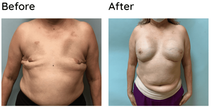 Understanding Breast Revision Surgery