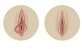 Understanding Vaginoplasty — Knowledge Empowers Women